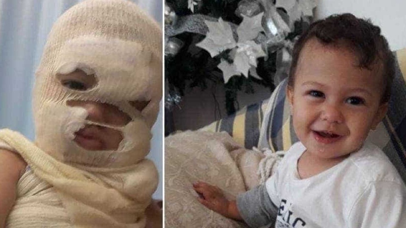 ‘Desespero’: bebê tem rosto desfigurado por água fervendo e pais pedem ajuda
