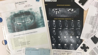 Identificação por meio da arcada dentária em um exame exame pericial odontoforense