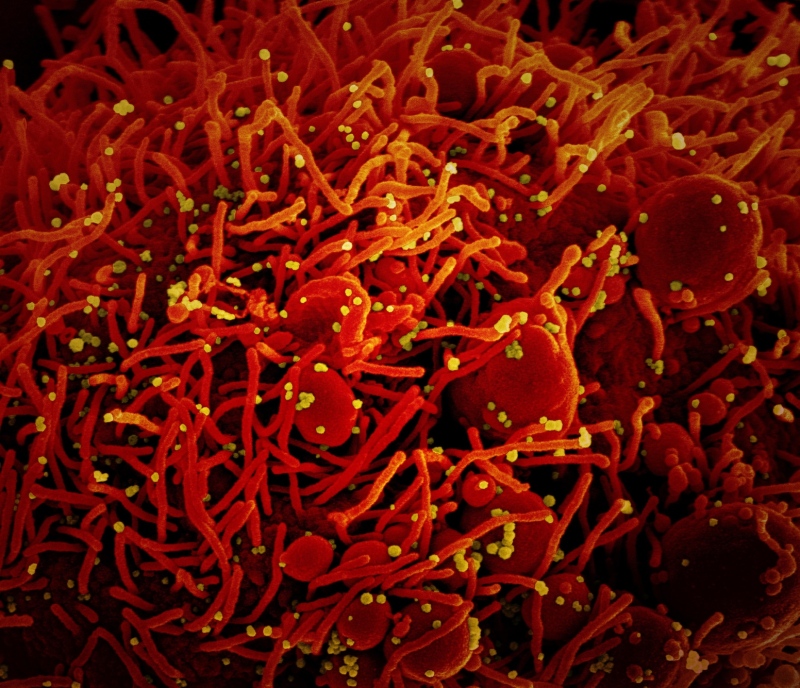 Célula apoptótica (vermelha) infectada com partículas do vírus SARS-COV-2 (amarela)