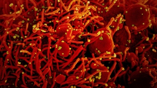 Célula apoptótica (vermelha) infectada com partículas do vírus SARS-COV-2 (amarela)